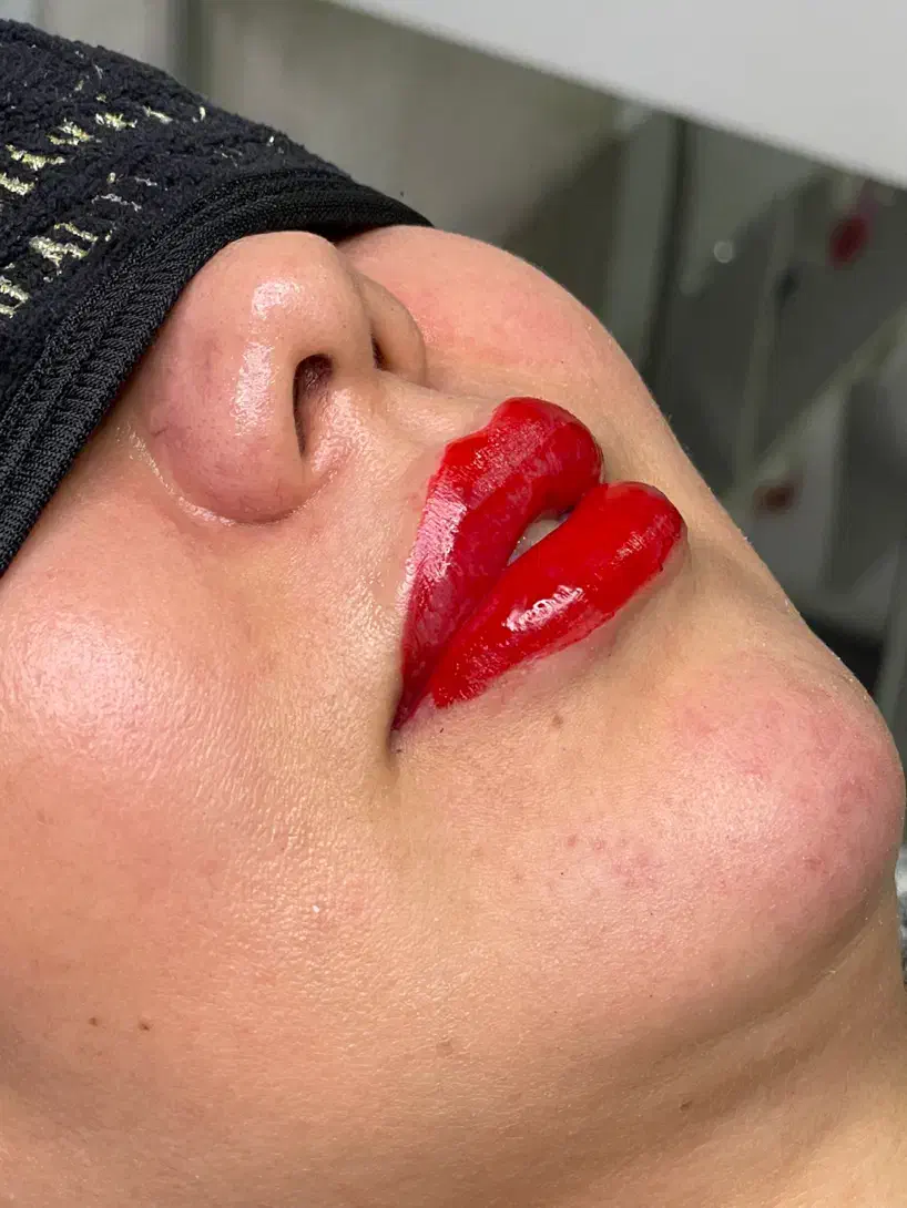 تزریق ژل و بوتاکس|خدمات آرایشگری و زیبایی|ارومیه, |دیوار