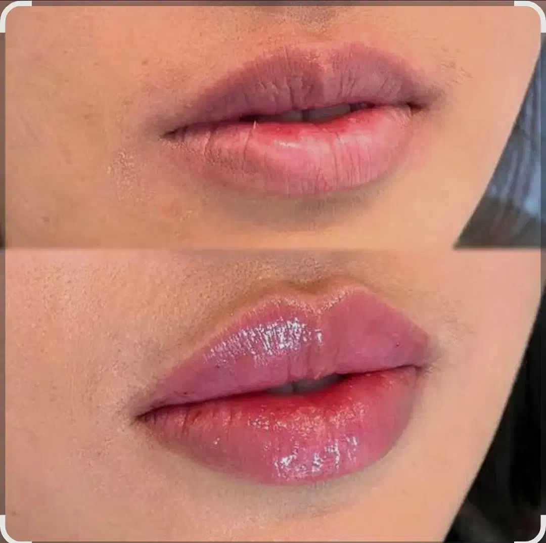 مدل بوتاکس ژل صورت|خدمات آرایشگری و زیبایی|شیراز, پارک آزادی|دیوار