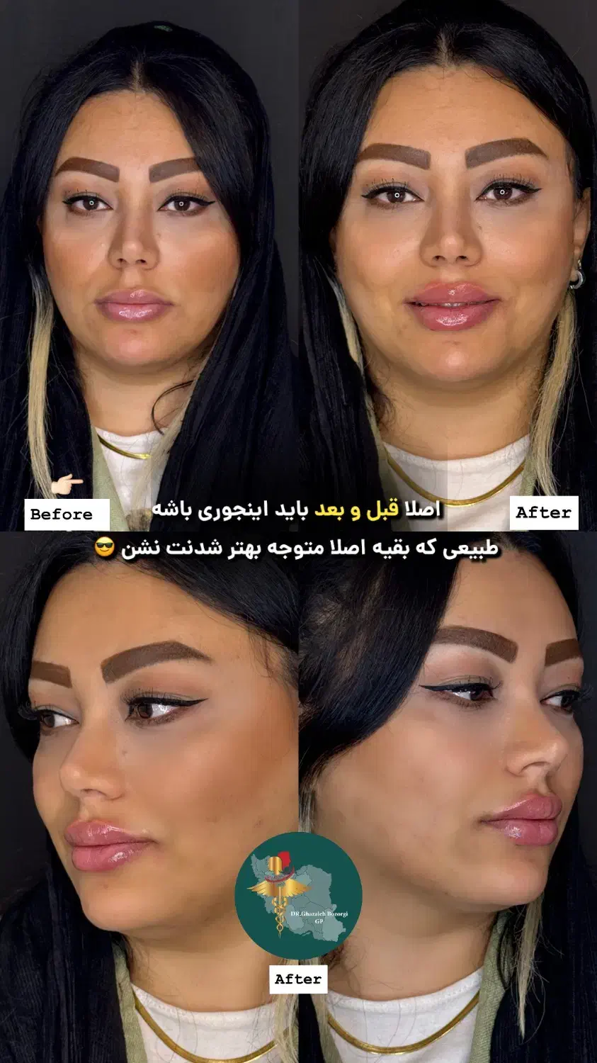 نیاز فوری به مانکن جهت تزریق بوتاکس و فیلر لب|خدمات آرایشگری و زیبایی|تهران, امانیه|دیوار