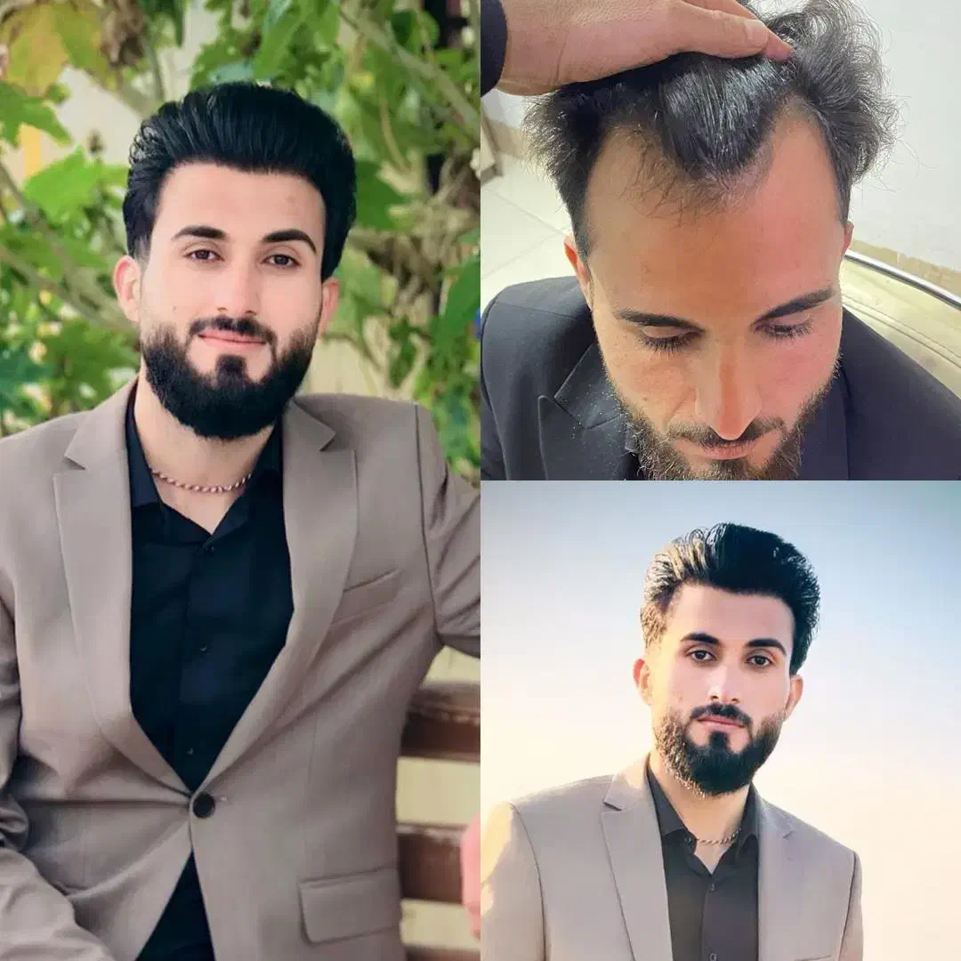 پرتراکم ترین کاشت مو در ایران با ضمانت نامه|خدمات آرایشگری و زیبایی|تهران, زعفرانیه|دیوار