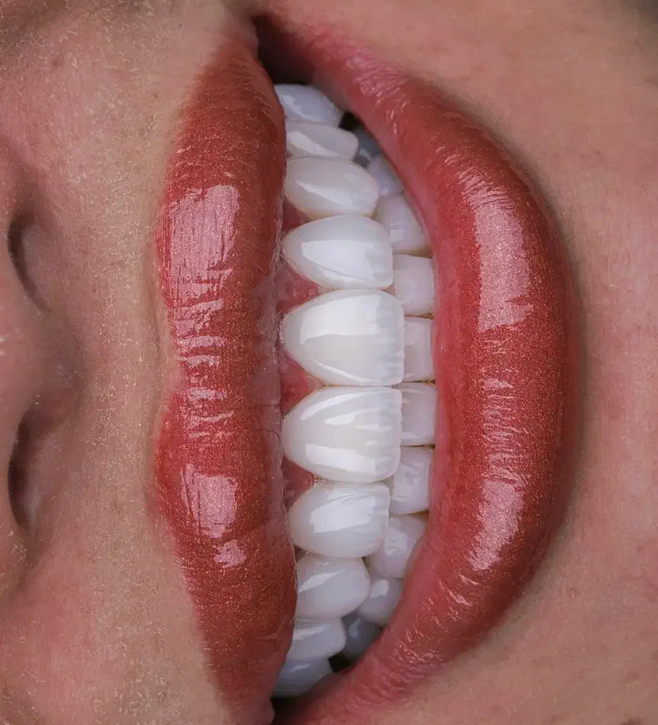 کامپوزیت دندان روش لیرینگ با ضمانت|خدمات آرایشگری و زیبایی|مشهد, فلسطین|دیوار