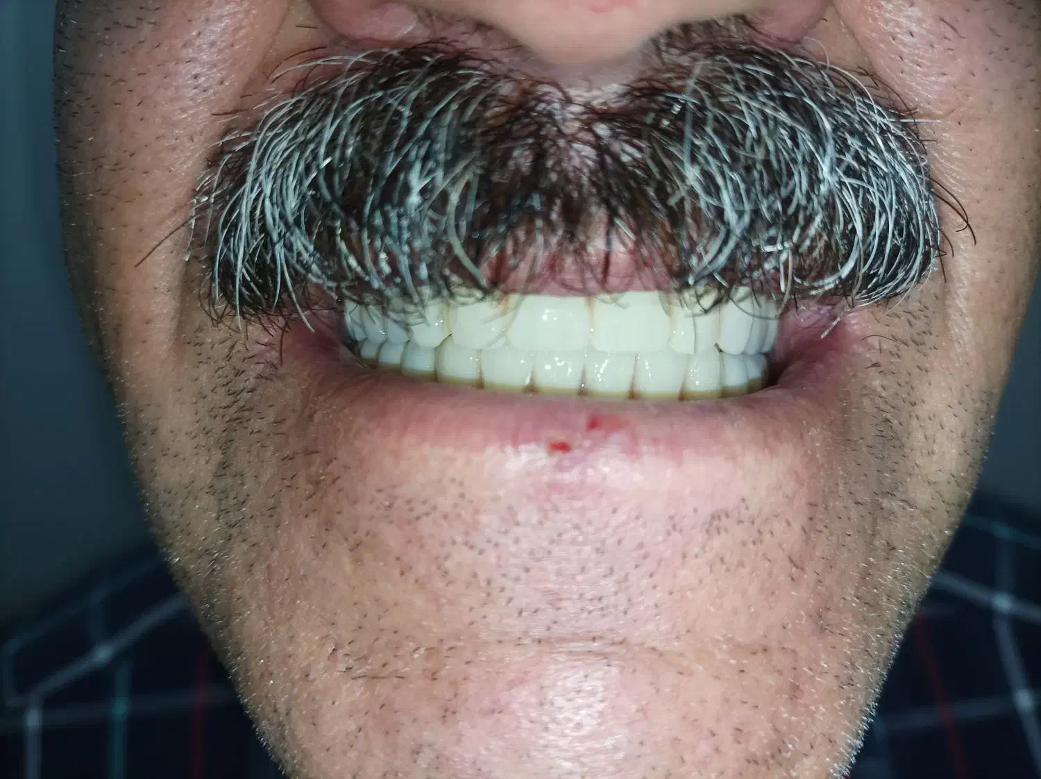 لابراتوار دندانسازی، دندان مصنوعی|آرایشی، بهداشتی، درمانی|تبریز, |دیوار