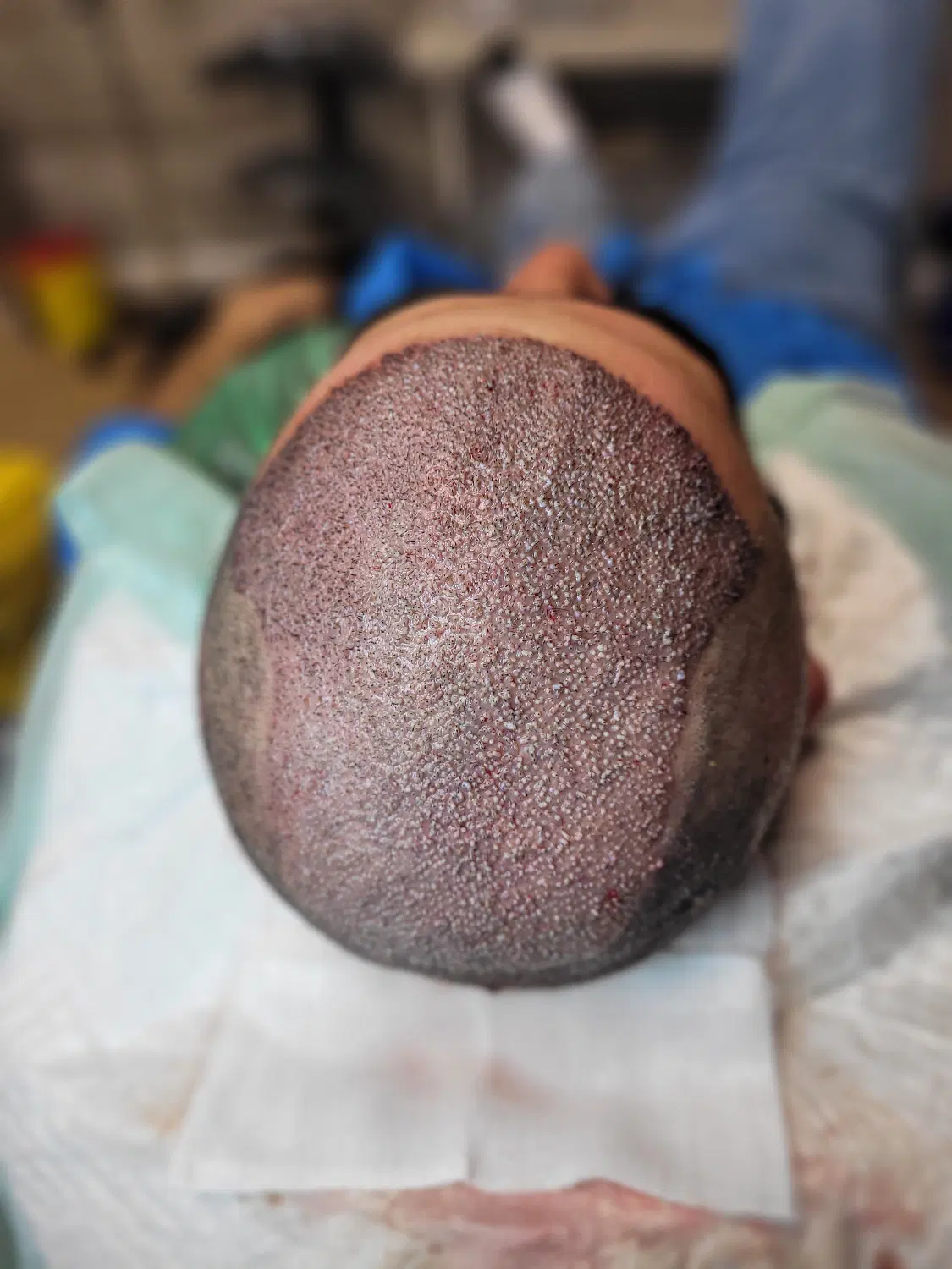 کاشت ریش/جذابیت مردونه ات روچندبرابرکن|خدمات زیبایی و سلامت|تبریز, |دیوار