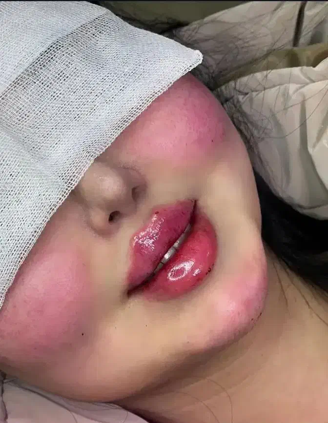 ساکشن چربی ،تزریق چربی ، تزریق ژل ،فیلر لب بلفارو|خدمات آرایشگری و زیبایی|خرم‌آباد, |دیوار