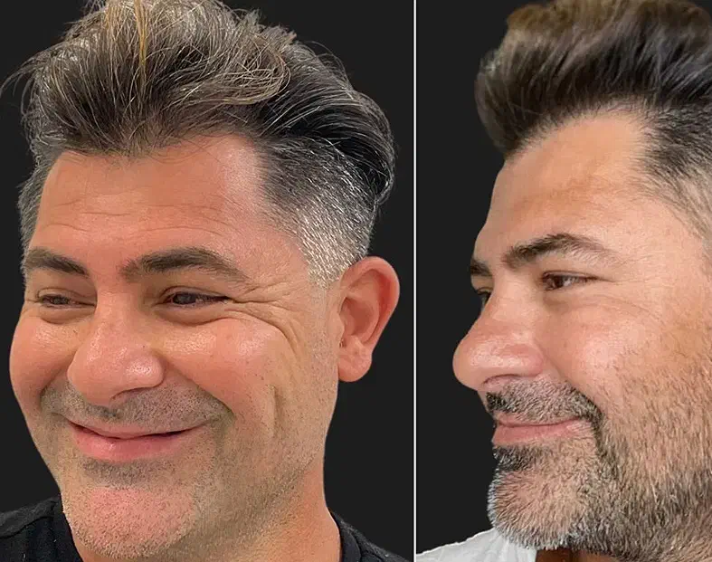 تخفیف پاییزی بوتاکس کلینیک زیبایی|خدمات آرایشگری و زیبایی|اردبیل, |دیوار