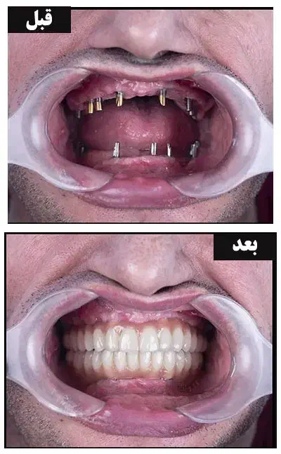 ایمپلنت دندان سوئیسی فقط 7 میلیون|خدمات آرایشگری و زیبایی|تهران, توحید|دیوار
