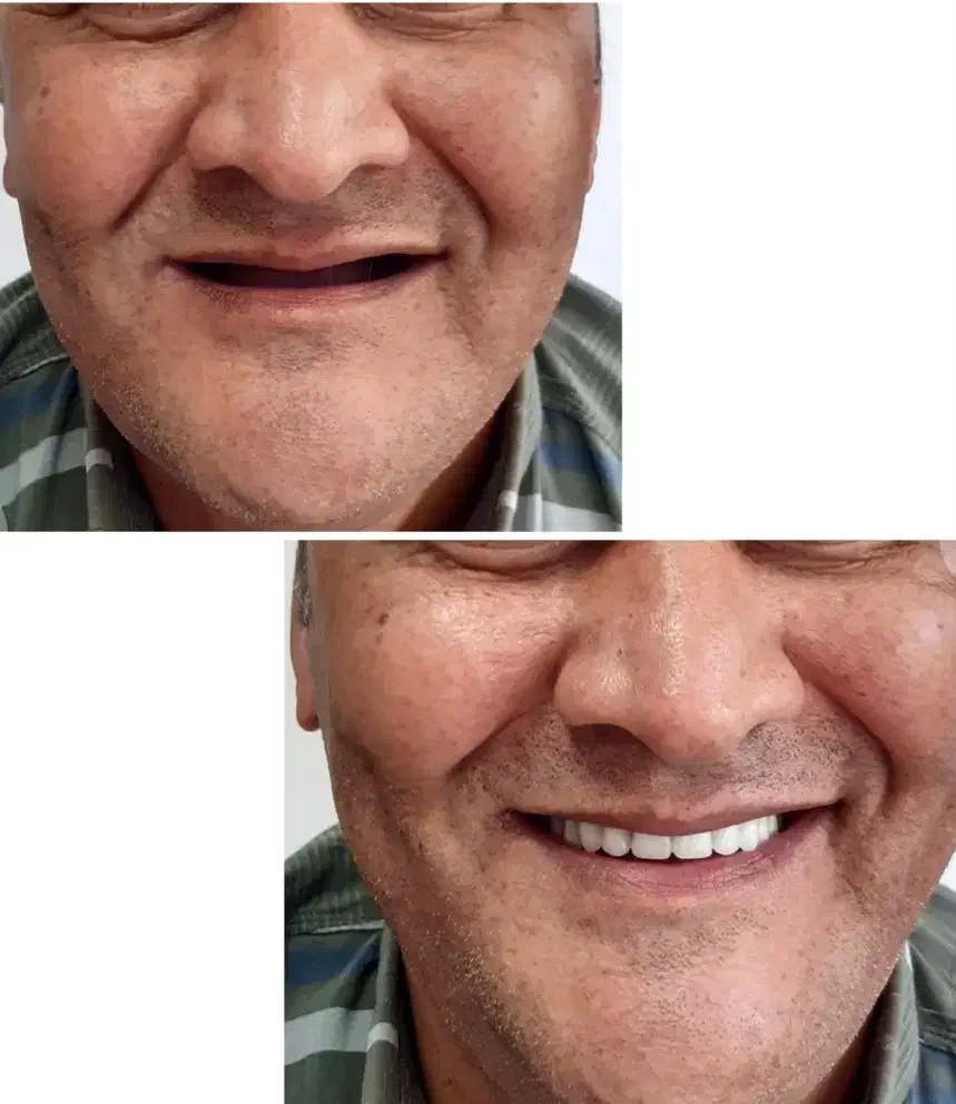 ترمیم عصب کشی روکش کامپوزیت زیبایی|خدمات آرایشگری و زیبایی|اردبیل, |دیوار