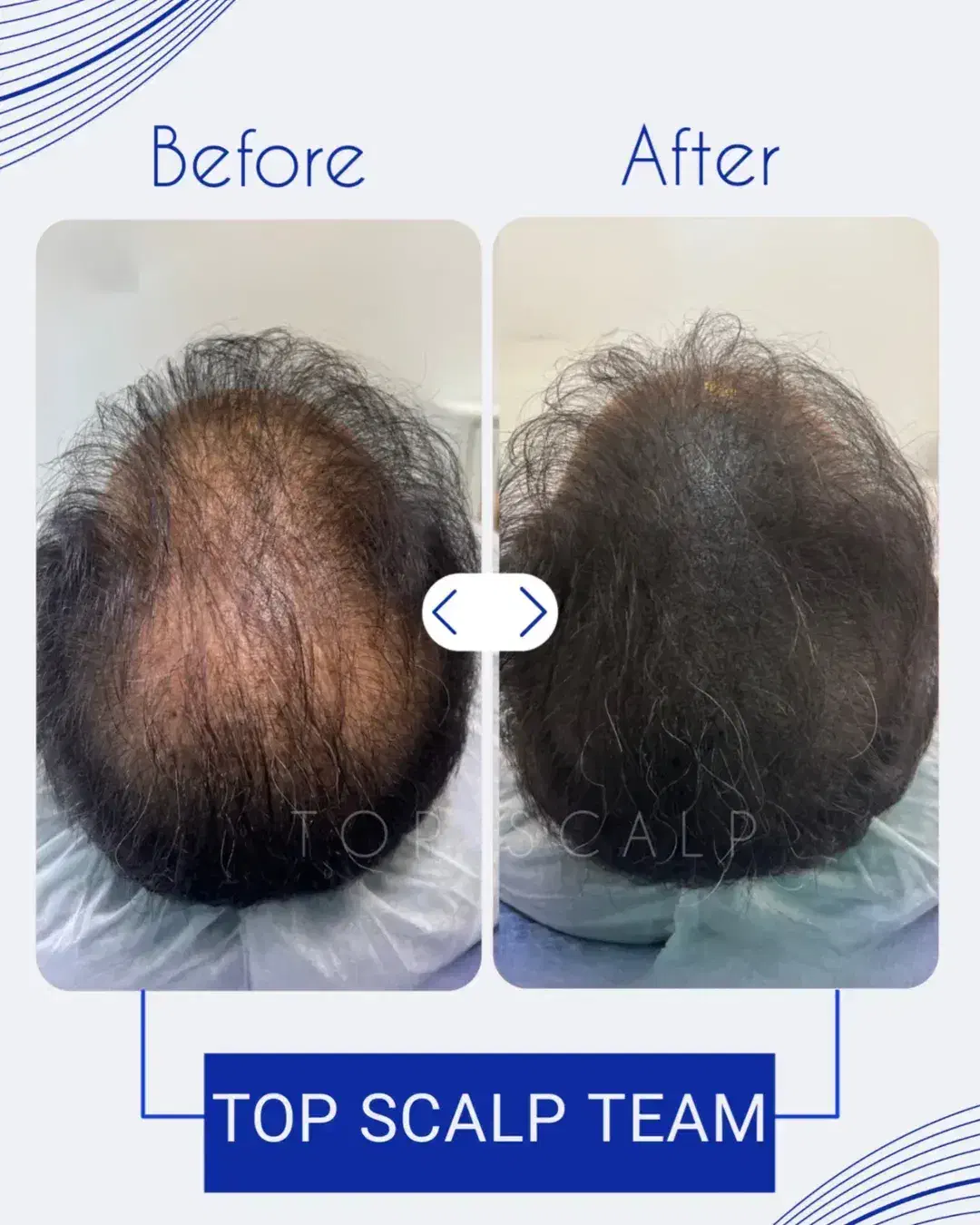 میکرو اسکالپ مکمل کاشت مو|خدمات آرایشگری و زیبایی|یاسوج, |دیوار