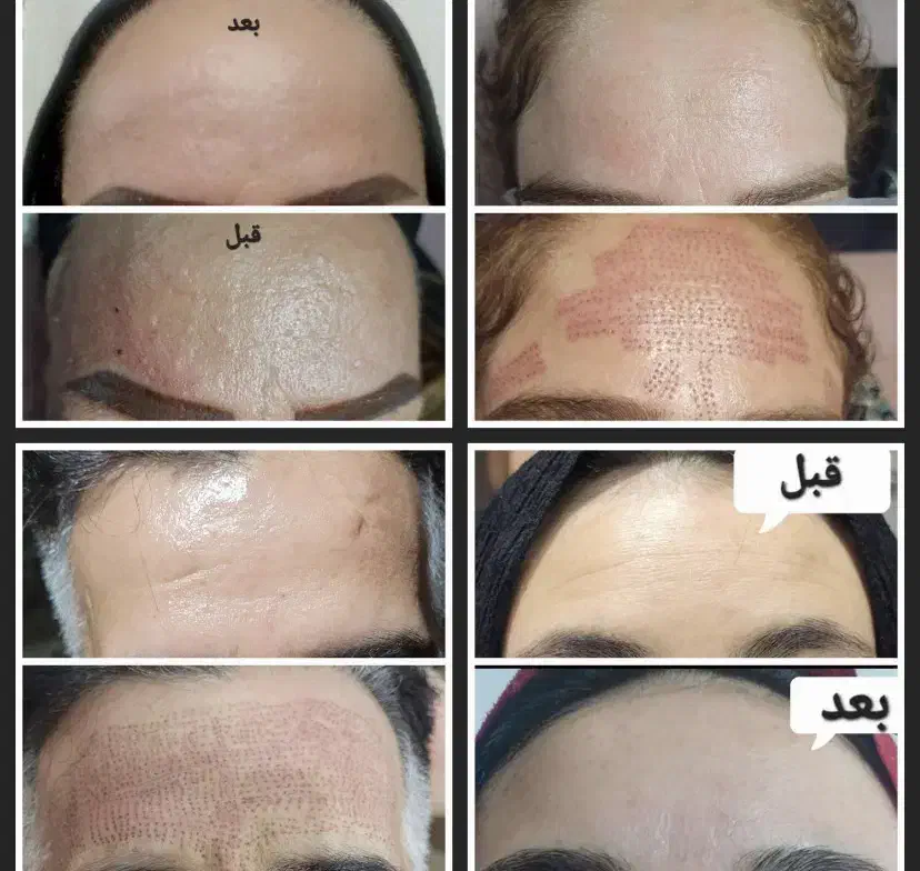 اموزش خدمات پلاسما کک ومک لک خال مزو کرمپودردائم|خدمات آرایشگری و زیبایی|قم, زنبیل آباد|دیوار