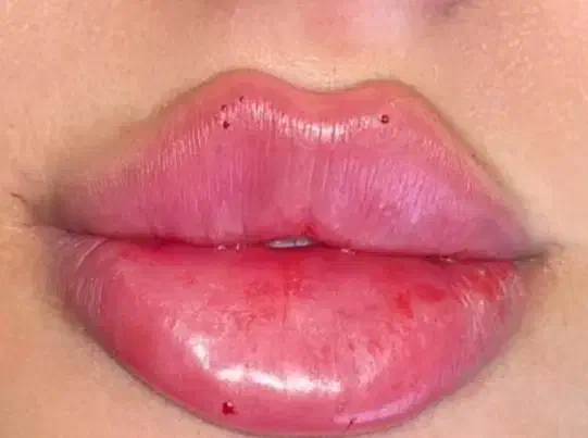 تزریق ژل و بوتاکس|خدمات آرایشگری و زیبایی|اردبیل, |دیوار