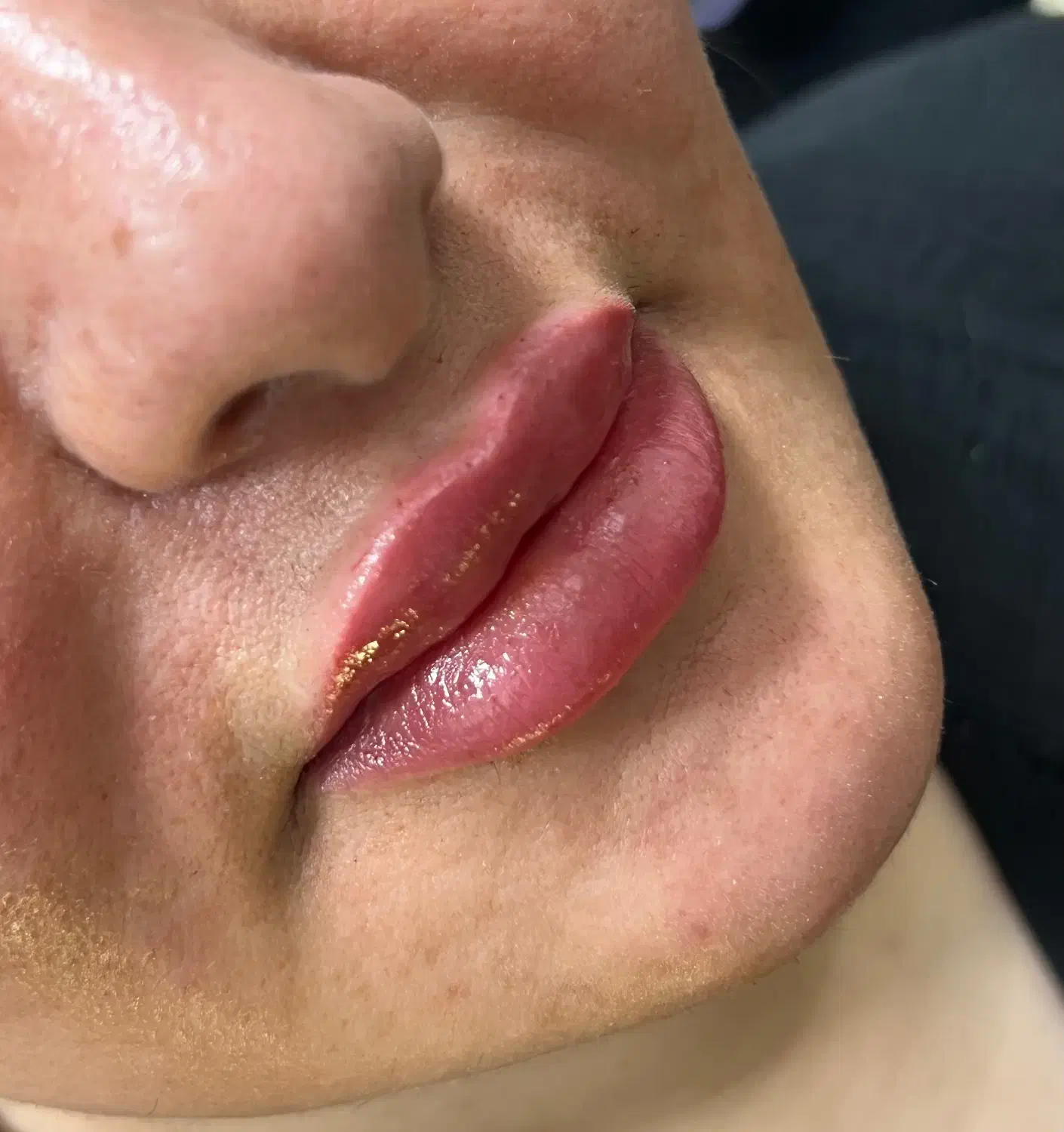 تزریق فیلر و بوتاکس|خدمات آرایشگری و زیبایی|قرچک, مهدیه|دیوار