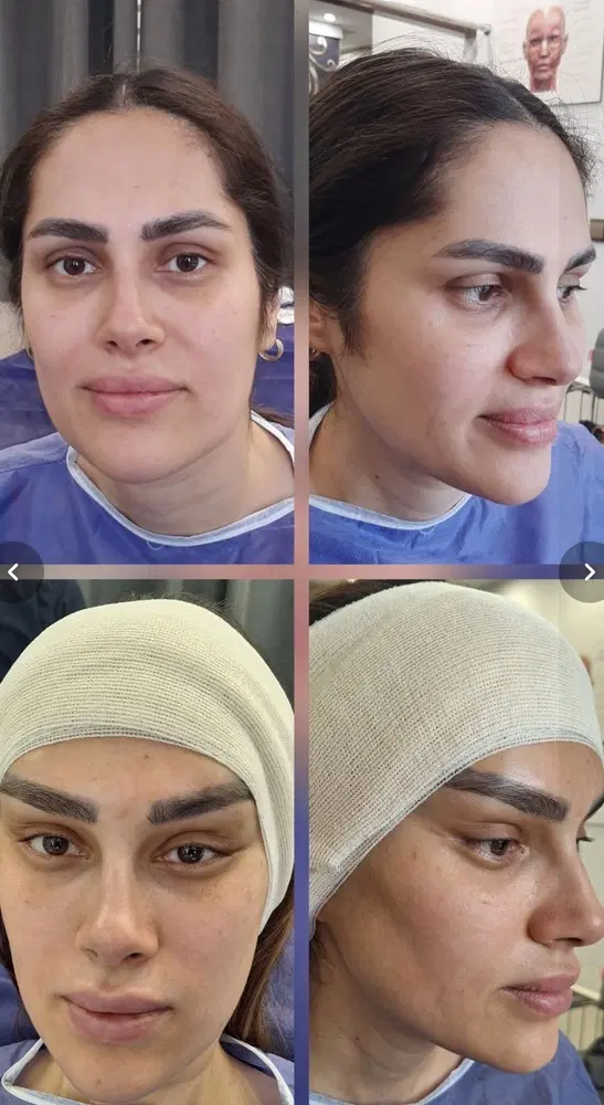 مینی لیفت شقیقه گونه اندولیفت ابروبلفارو|خدمات زیبایی و سلامت|تهران, میدان ولیعصر|دیوار