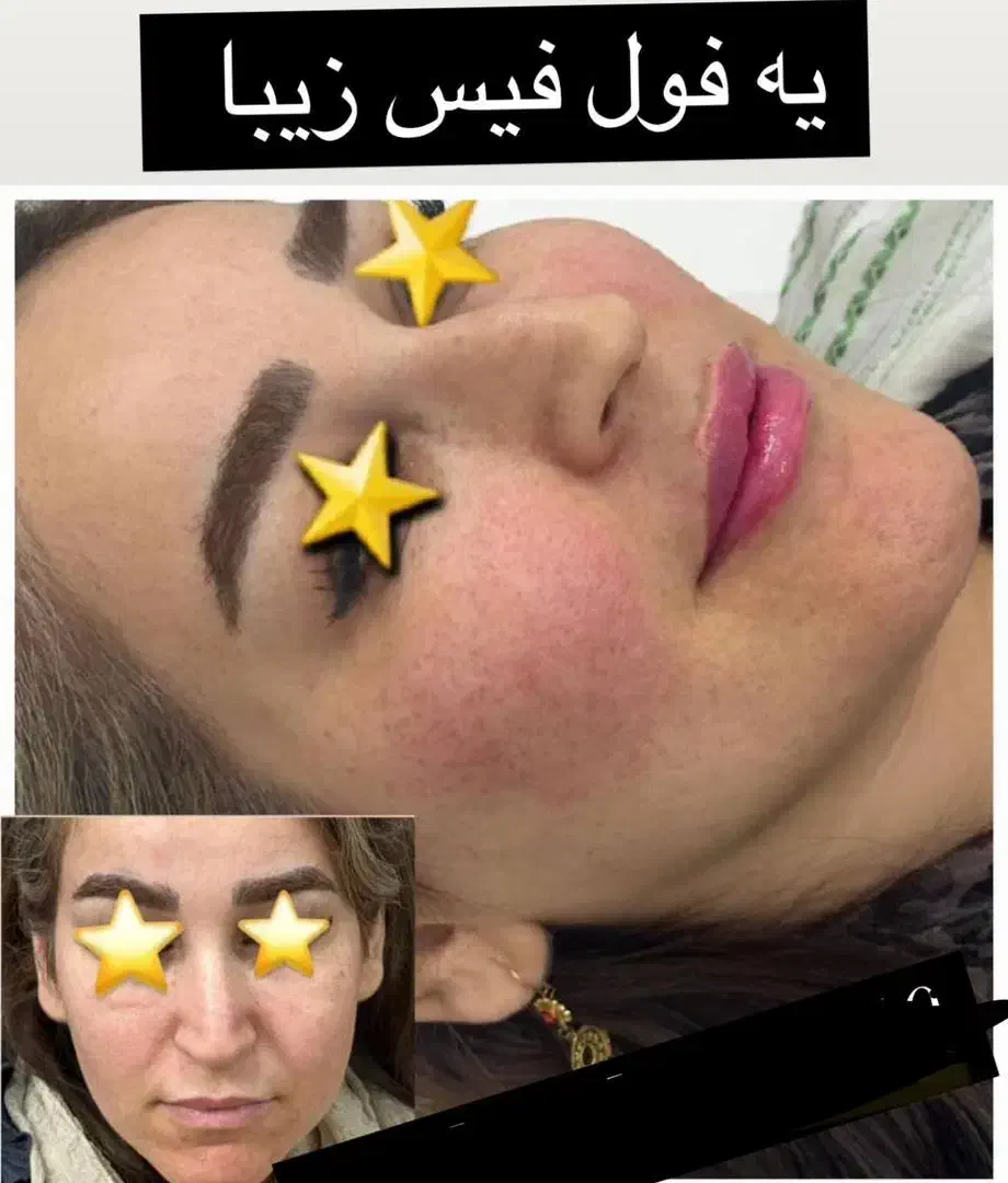 تزریق ژل و بوتاکس و پی ارپی و مزوتراپی و لیزر مو|خدمات آرایشگری و زیبایی|بوشهر, |دیوار