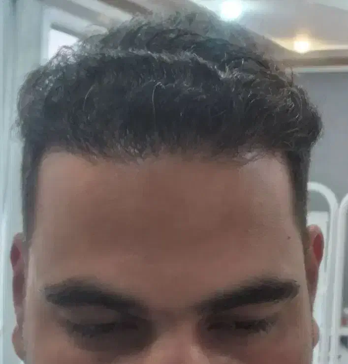 کاشت مو فول تراکم اقساطی برای اولین بار در رفسنجان|خدمات آرایشگری و زیبایی|رفسنجان, |دیوار