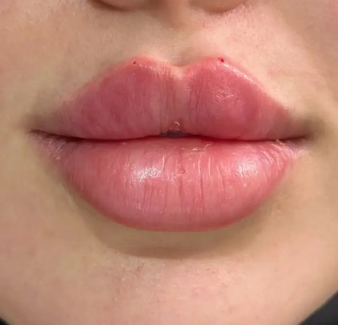 تزریقات زیبایی وجوانسازوفیلرها باتخفیف ویژه|خدمات آرایشگری و زیبایی|دوگنبدان, |دیوار