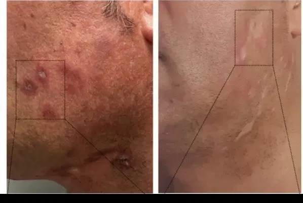لک و التهاب‌های عجیب پوستت تکرار می‌شن|خوردنی و آشامیدنی|تهران, یوسف‌آباد|دیوار