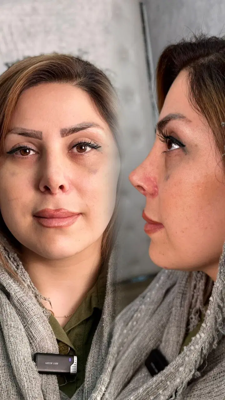 زیبایی بینی|خدمات آرایشگری و زیبایی|شیروان (خراسان), |دیوار