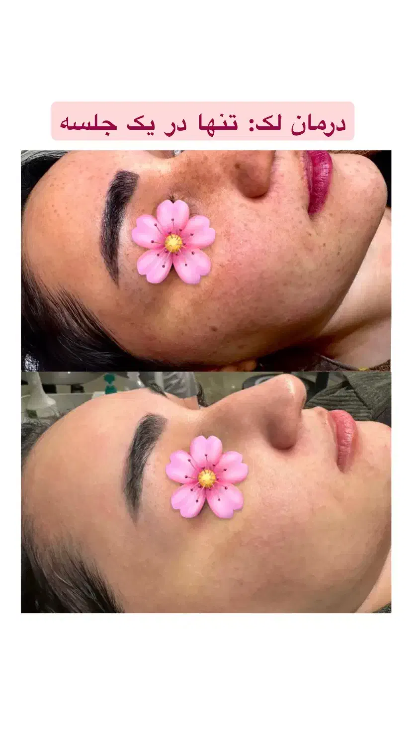 لیزر موهای زائد فول بادی ۴۹۰ تومان|خدمات آرایشگری و زیبایی|رشت, گلسار|دیوار