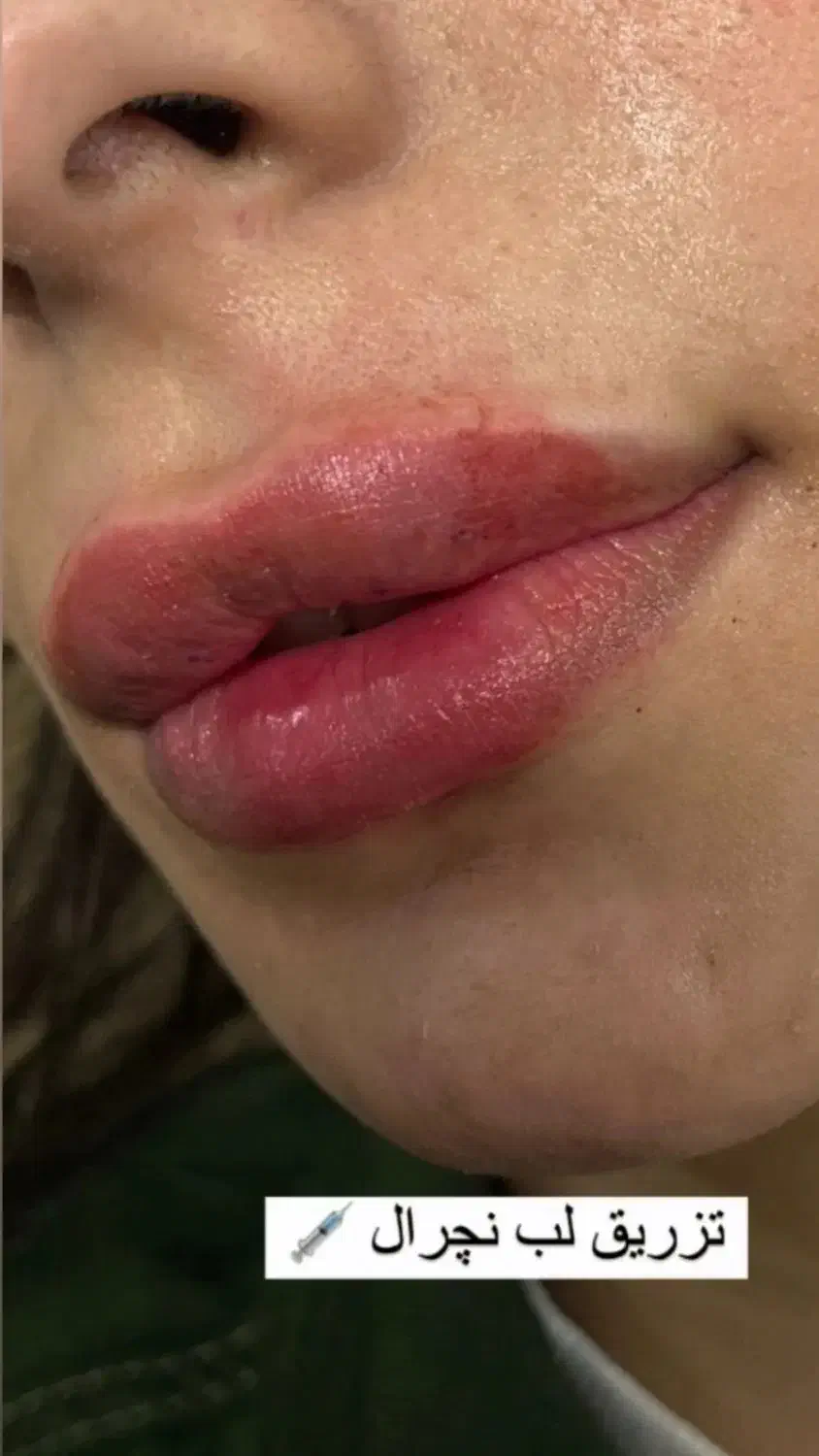 آموزش و انجام تمام خدمات ژل و بوتاکس|خدمات آرایشگری و زیبایی|هشتگرد, شهرک ولیعصر (مصلی)|دیوار