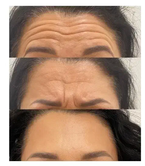 لیزر، بوتاکس، فیلر، جوانسازی|خدمات آرایشگری و زیبایی|ورامین, ورامین|دیوار