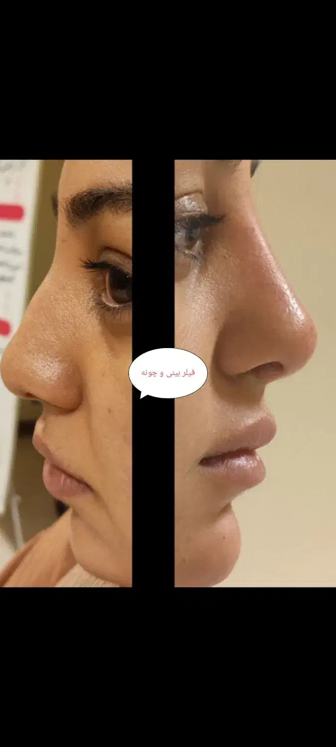 ترریق ژل و بوتاکس|خدمات آرایشگری و زیبایی|اصفهان, کوی شهید کشوری|دیوار