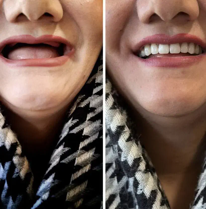 دندانسازی مصنوعی دندان مصنوعی با کیفیت و زیبا|خدمات آرایشگری و زیبایی|تبریز, |دیوار