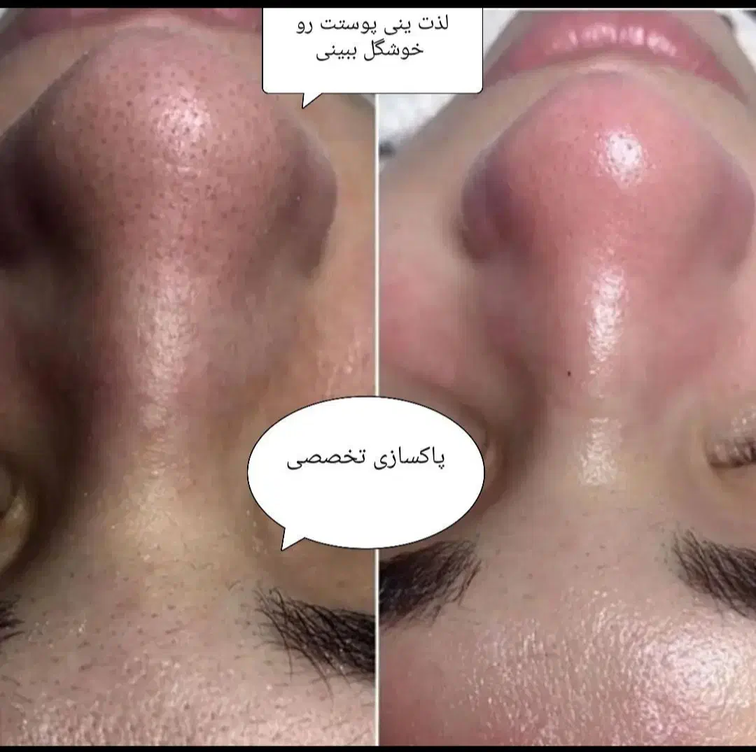 پاکسازی،فیشیال تخصصی،درمان مشکلات پوستی(تخفیف)|خدمات آرایشگری و زیبایی|گرگان, |دیوار