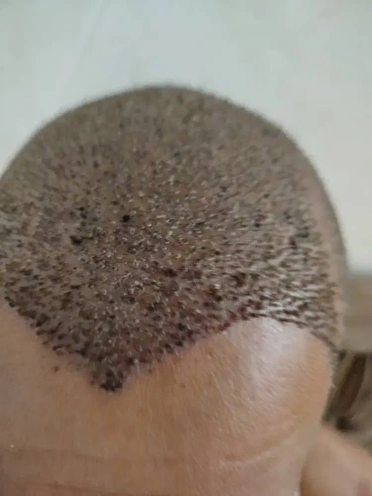 کاشت مو،ریش ،سیبیل،ابرو،پی آرپی ومزوتراپی|خدمات آرایشگری و زیبایی|بوشهر, |دیوار