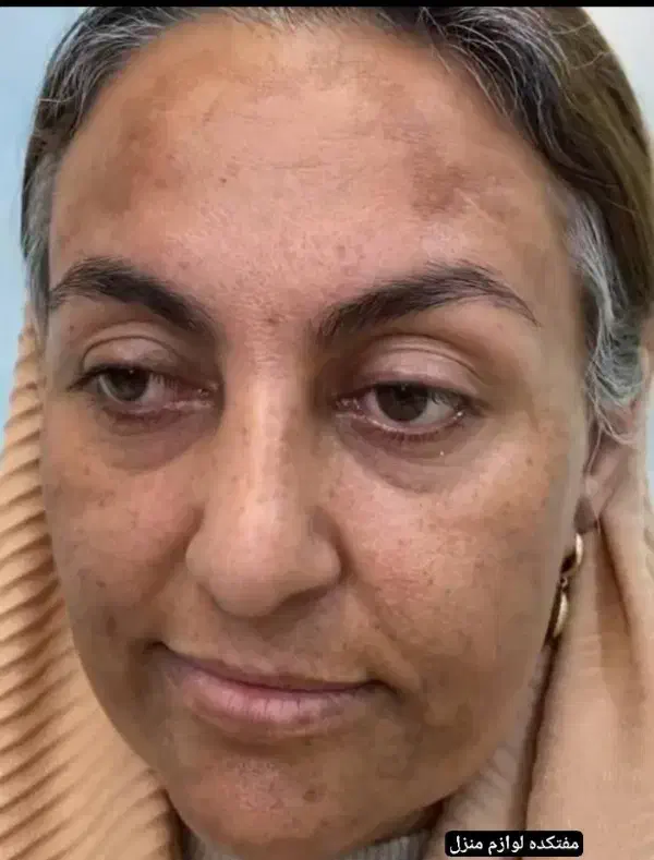 کرم معجزه اصلی دستساز متخصص تهران|آرایشی، بهداشتی، درمانی|کوهدشت, |دیوار