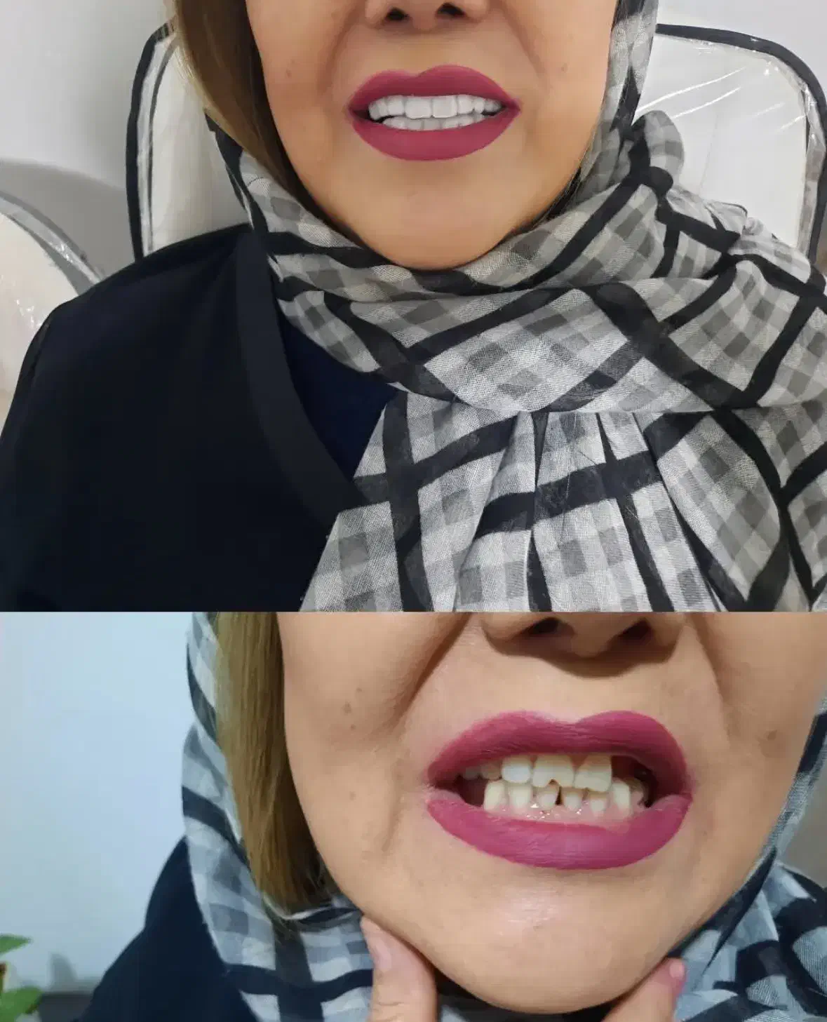 کامپوزیت متحرک دندان فوری|خدمات آرایشگری و زیبایی|مشهد, جانباز|دیوار