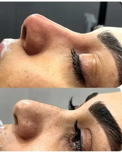 ژل لب فیلر بوتاکس پی ار پی فیلر گونه خط خنده|خدمات آرایشگری و زیبایی|کاشان, طالقانی|دیوار