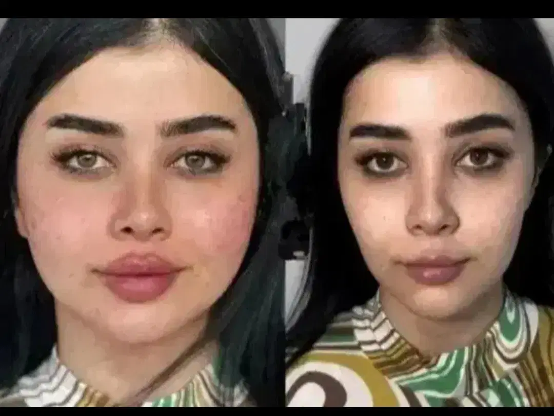 زاویه سازی.ژل.فیلر.نخ.انزیم مزو بوتاکس دکتر داریوش|خدمات زیبایی و سلامت|مشهد, گوهرشاد|دیوار