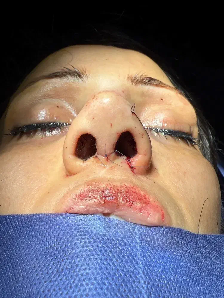 رینوپلاستی ۲۵میلیون|خدمات آرایشگری و زیبایی|قرچک, زیبا شهر|دیوار