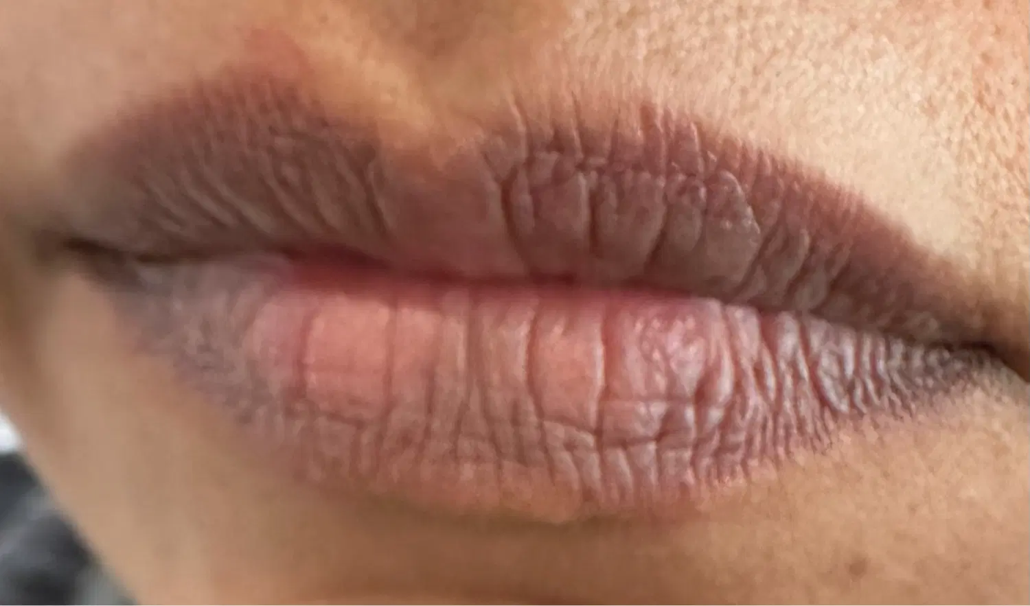 مزونیدلینگ مزوتراپی خالبرداری لیزر|خدمات زیبایی و سلامت|تهران, میرداماد|دیوار