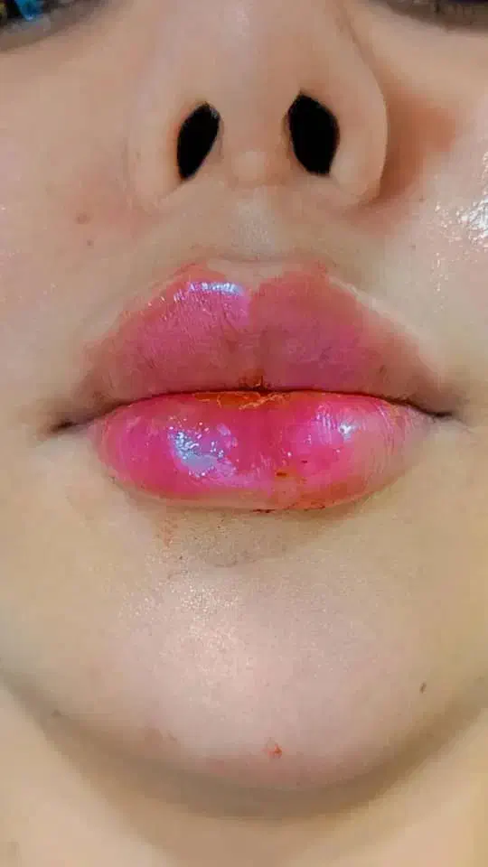 ژل فیلر بوتاکس آفر ویژه|خدمات آرایشگری و زیبایی|شیراز, سلطان آباد|دیوار