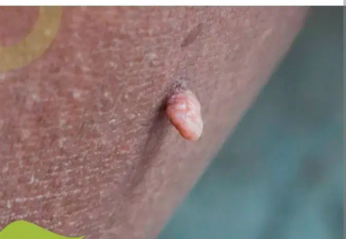 درمان تخصصی زگیل تناسلی توسط پزشک متخصص|خدمات آرایشگری و زیبایی|شیراز, میرزاکوچک خان|دیوار