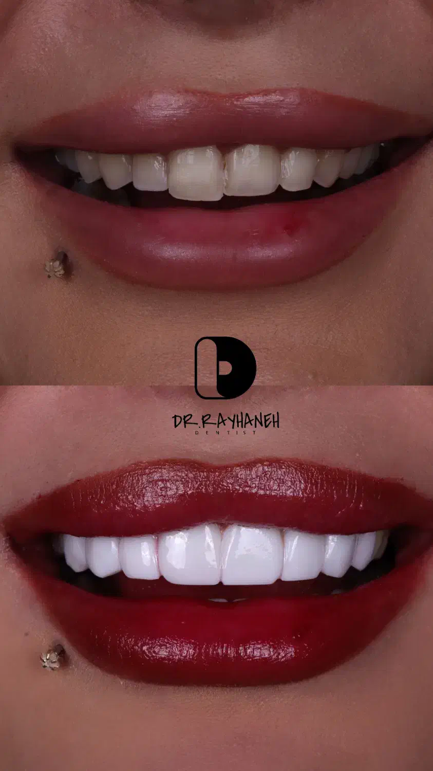 کامپوزیت دندان/لمینیت/دندانپزشکی|خدمات آرایشگری و زیبایی|مشهد, کوثر|دیوار