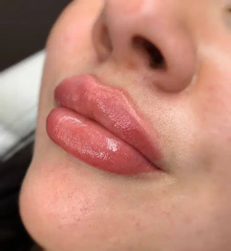 ژل فیلر بوتاکس مزو هایفو لیزر نخ|خدمات آرایشگری و زیبایی|اسلام‌شهر, باغ فیض|دیوار