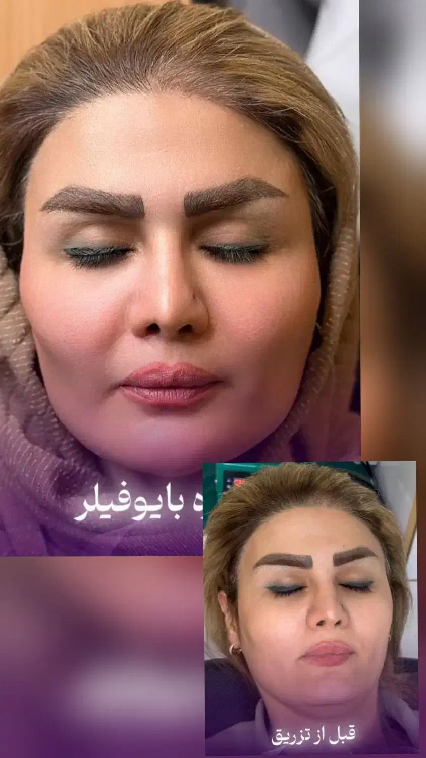 تزریق ژل طبیعی فیلر بوتاکس(کلینیک زیبایی گلد)|خدمات آرایشگری و زیبایی|سنندج, |دیوار