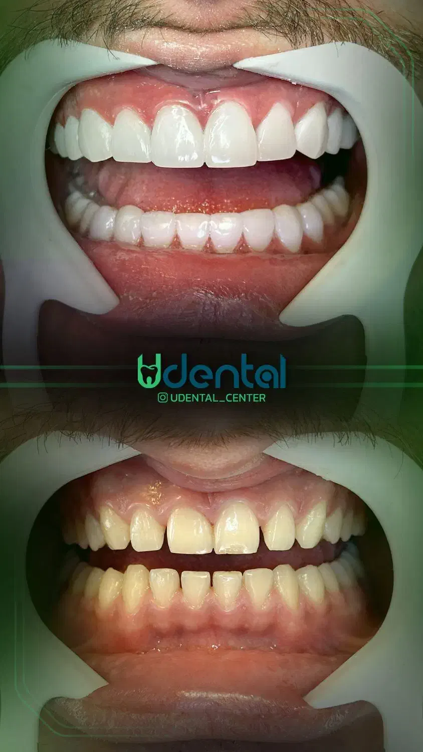 کامپوزیت، لمینت، ایمپلنت اقساط ویژه|خدمات آرایشگری و زیبایی|ری, شهرری|دیوار