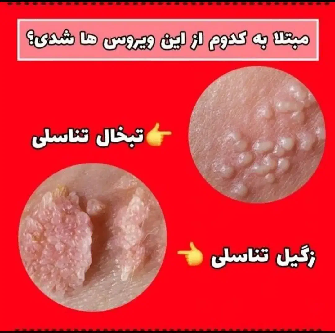 درمان ریشه ای زگیل و تبخال به صورت گیاهی|آرایشی، بهداشتی، درمانی|ساری, |دیوار