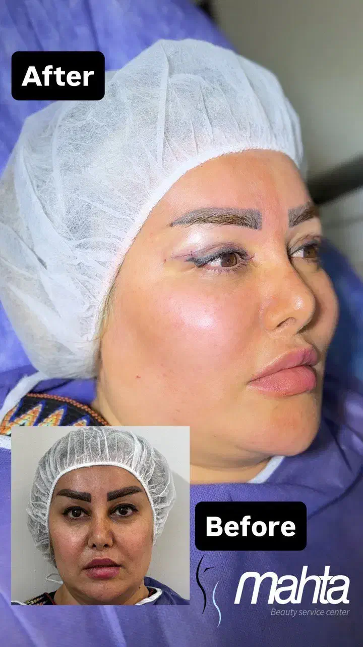 تخفیف ویژه عمل افتادگی پلک بلفاروپلاستی نقدو اقساط|خدمات آرایشگری و زیبایی|تهران, تهرانسر مرکزی|دیوار