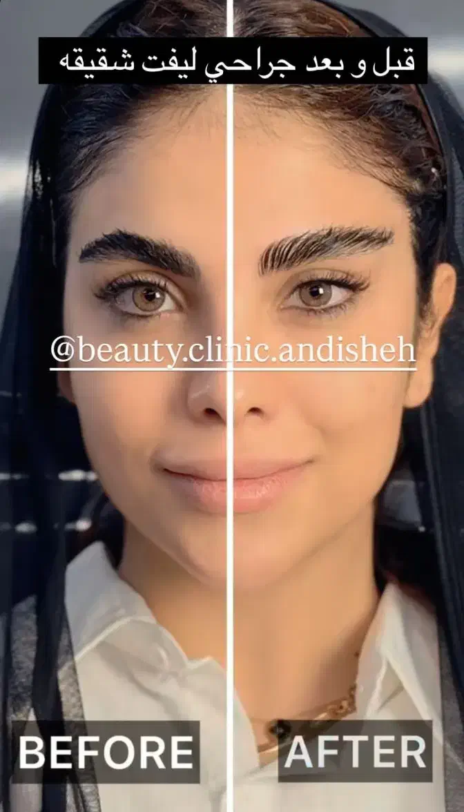 جراحی زیبایی بلفاروپلاستی،مینی لیفت صورت|خدمات آرایشگری و زیبایی|اندیشه, اندیشه فاز ۱|دیوار