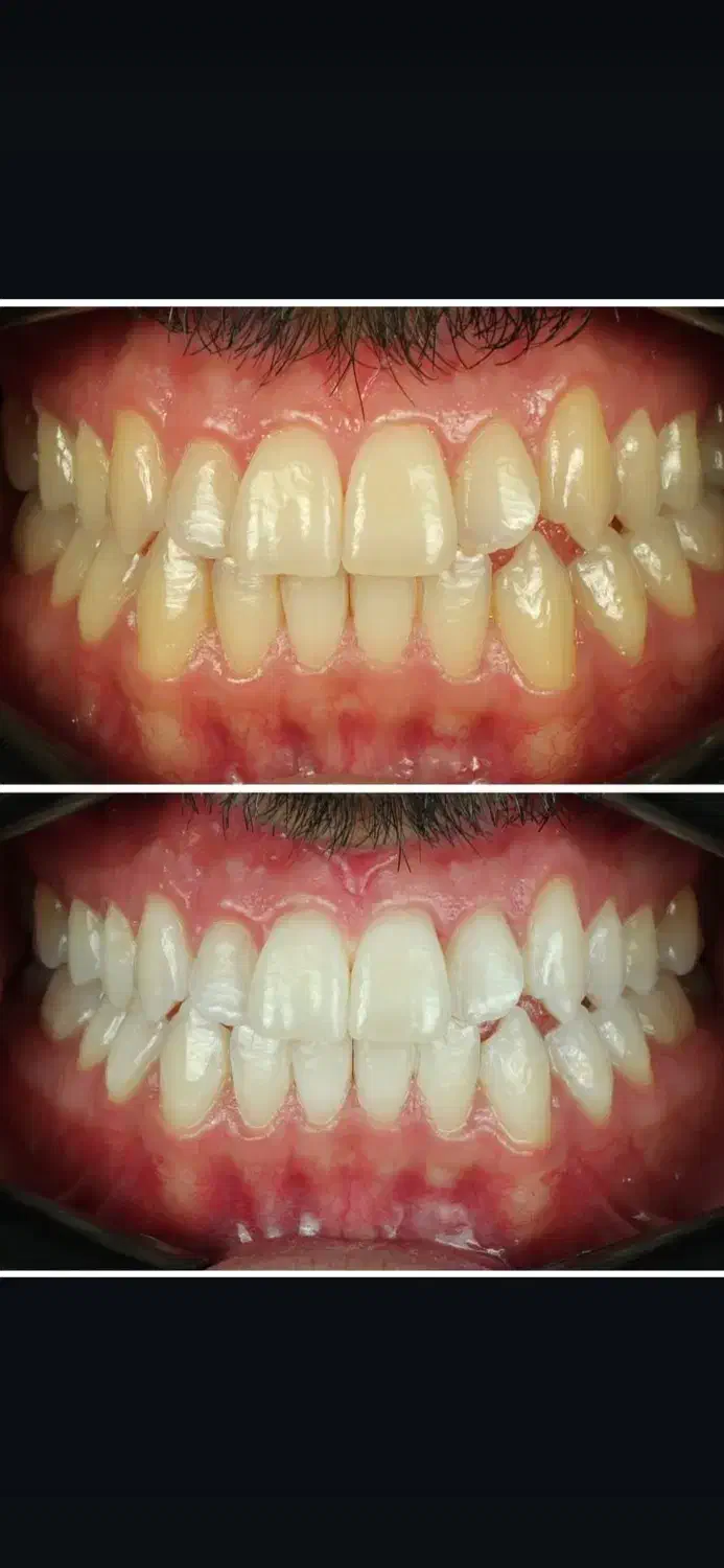 مدل خوش فیس برای بلیچینگ و سفیدکردن دندان|خدمات آرایشگری و زیبایی|تهران, دریاچه شهدای خلیج فارس|دیوار