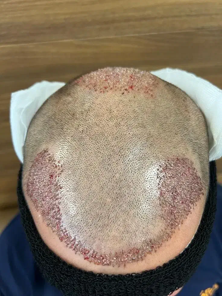 کاشت مو تضمینی با روش fit|خدمات آرایشگری و زیبایی|تبریز, |دیوار