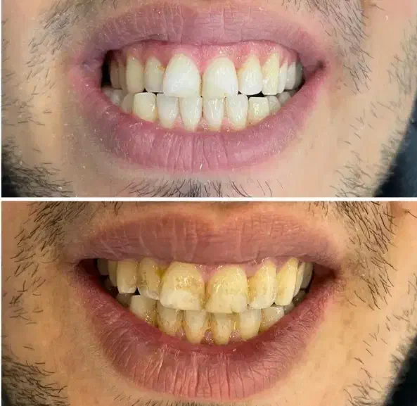 دندانپزشکی دندانسازی روکش|خدمات آرایشگری و زیبایی|نورآباد, |دیوار