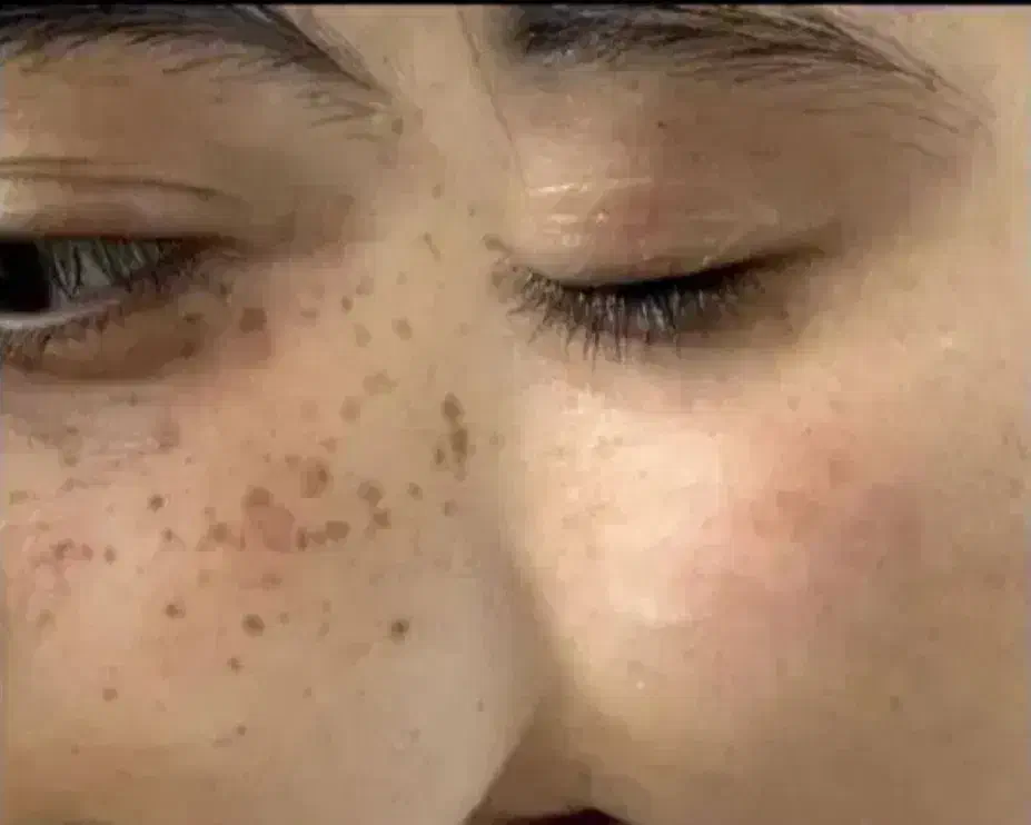 حذف خال، کک و مک و زوائد پوستی با کمترین قیمت|خدمات آرایشگری و زیبایی|یاسوج, |دیوار