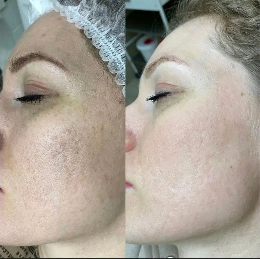 کربن تراپی (پیلینگ هالیودی)در مطب پزشک|خدمات آرایشگری و زیبایی|قم, بلوار امین و ساحلی|دیوار