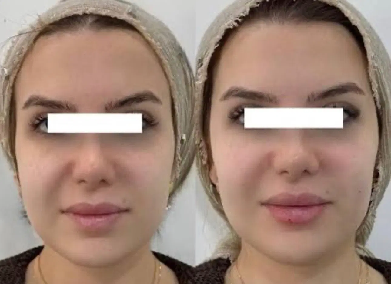 تزریق فیلر و بوتاکس و ترمیم با کمترین هزینه|خدمات زیبایی و سلامت|تهران, ایران|دیوار