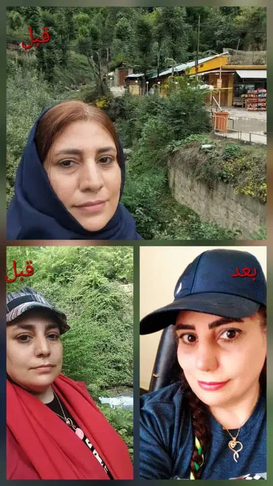 عمل زیبایی بینی در مازندران|خدمات آرایشگری و زیبایی|قائمشهر, |دیوار